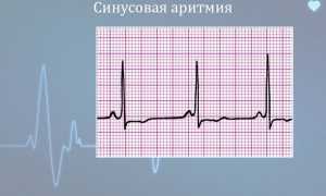 Синусовая аритмия сердца: что это значит, чем опасна, симптомы и лечение