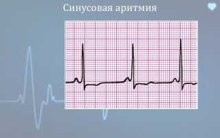 Синусовая аритмия сердца: что это значит, чем опасна, симптомы и лечение