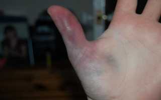 Признаки перелома пальца на руке – лечить или оставить как есть