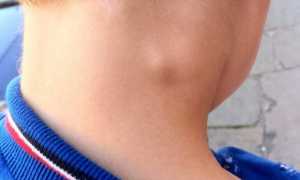 Воспаляется лимфоузел на шее у ребенка – 7 причин