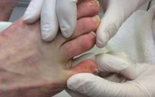 Мозоль между пальцев ног – чем лечить