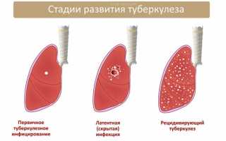 Как можно заразиться туберкулезом – механизмы и пути передачи