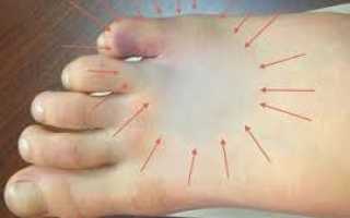 Симптомы перелома мизинца на ноге. Сколько заживает перелом?