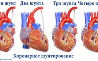 Коронарное шунтирование сосудов сердца – как проходит операция, статистика смертности и послеоперационный период