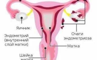 Лечение эндометриоза матки народными средствами